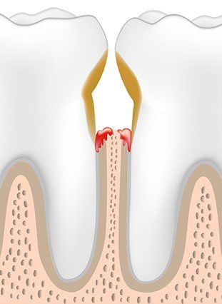 Cutaway graphic of an infected area between two teeth