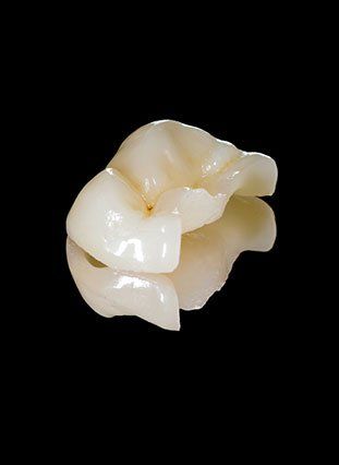Close-up of an onlay used for tooth restoration