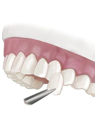 Illustration of veneer held up to teeth