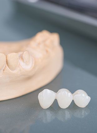 Photo of dental bridge and mold
