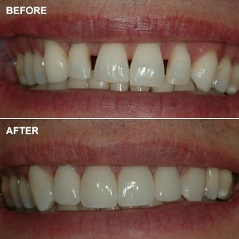 Close-up of mouth comparing natural teeth to porcelain veneers before cosmetic dentistry procedure