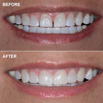 Close-up of chipped tooth before cosmetic dentistry procedure