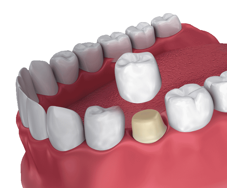 Dental Crown 3D Model