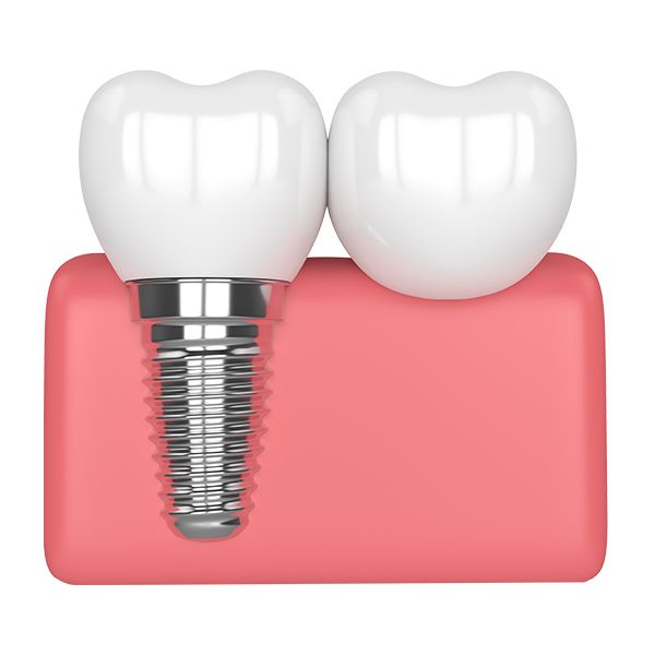 An illustration of a dental implant-supported crown