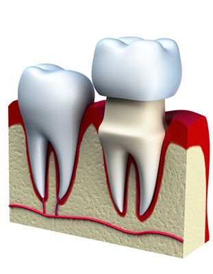 Illustration of dental crown being placed