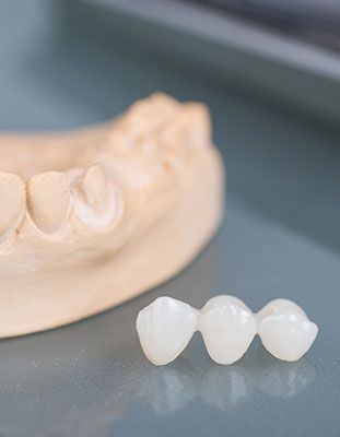 Dental bridge next to model