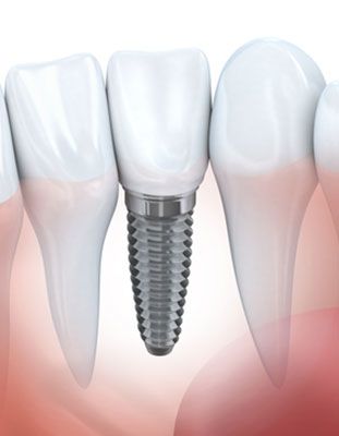 Illustration of dental implant