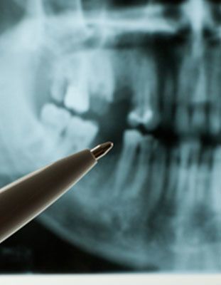 Pen next to dental x-ray