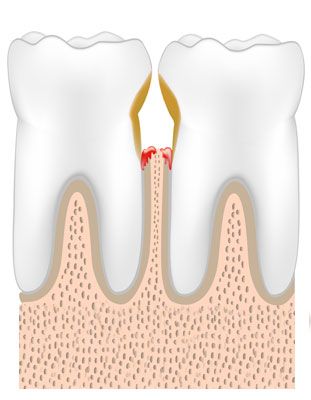 Illustration showing gum disease