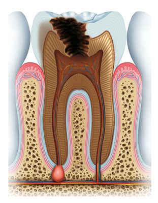 Illustration of infected tooth with large cavity