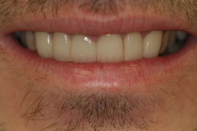 After crown placement