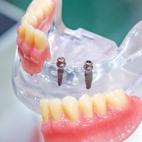 mini dental implants