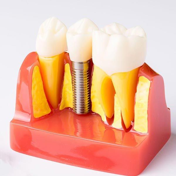 Traditional Dental Implants