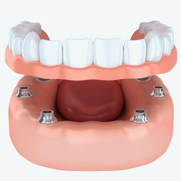TeethXpress®