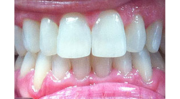 A patient's straight teeth after Six Month Smiles® treatment