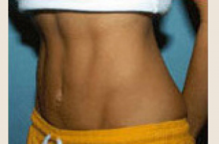 after - abdominoplasty
