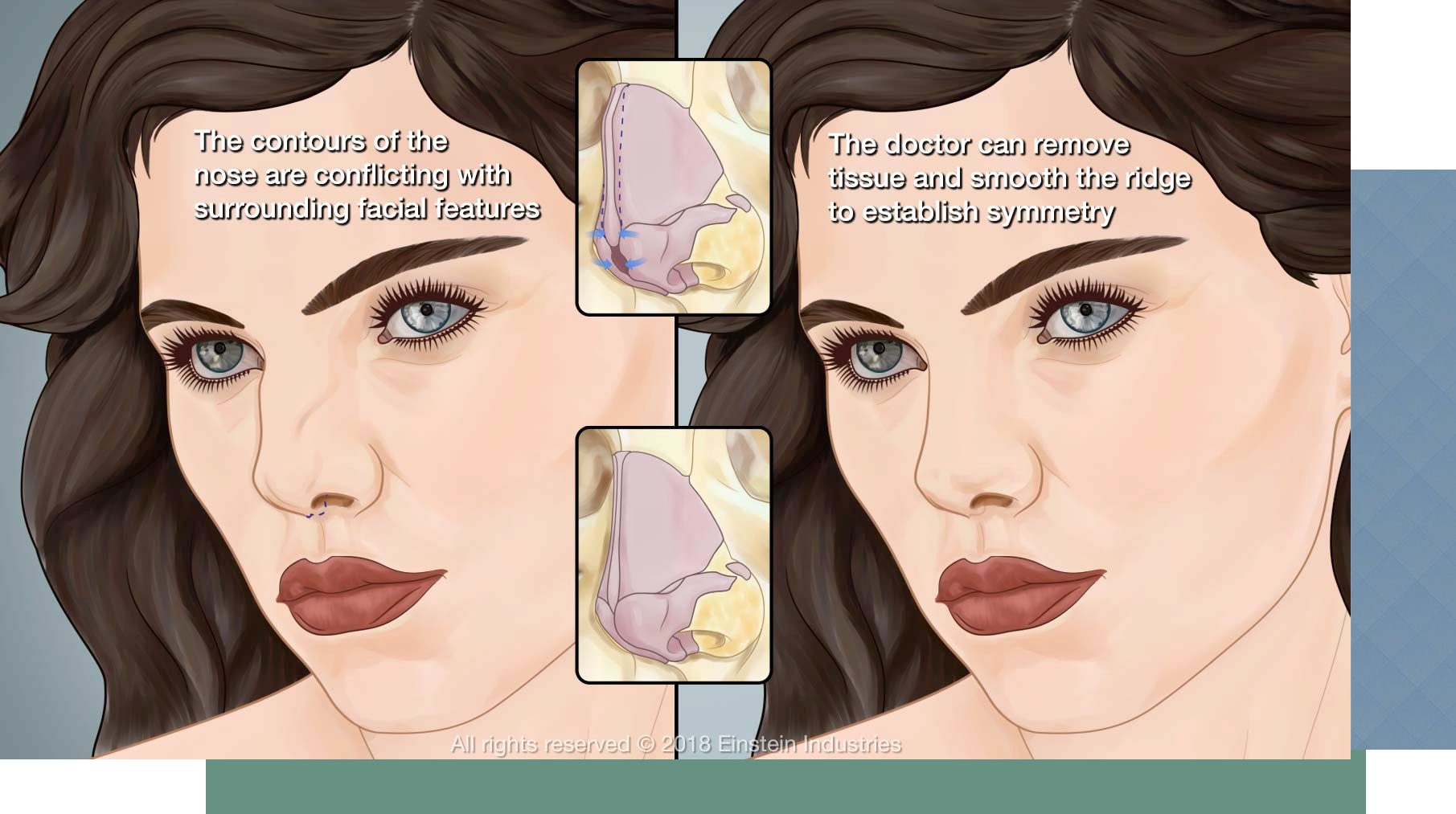 Rhinoplasty illustration