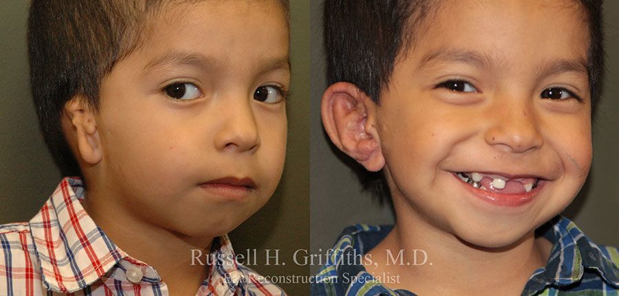 Before and After: One-stage microtia ear reconstruction surgery with canalplasty CAM 3/4 view.