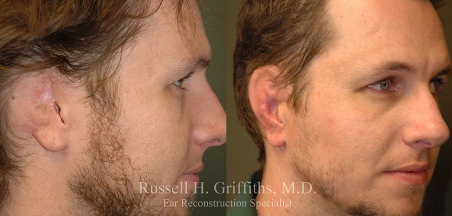 Before and After:  Ear Reconstruction Surgery after a bull riding accident Dr. Russell H. Griffiths MD