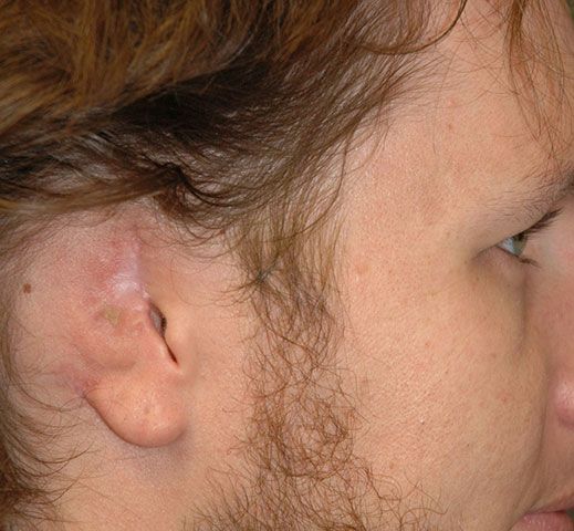 Close up profile view of young man with misshapen ear