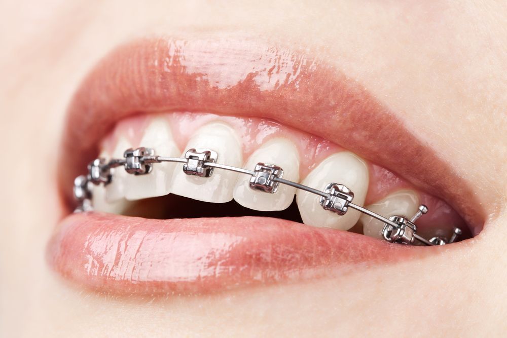 Close-up of a smile with metal braces