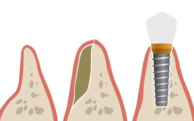 An illustrated example of a bone graft for a dental implant