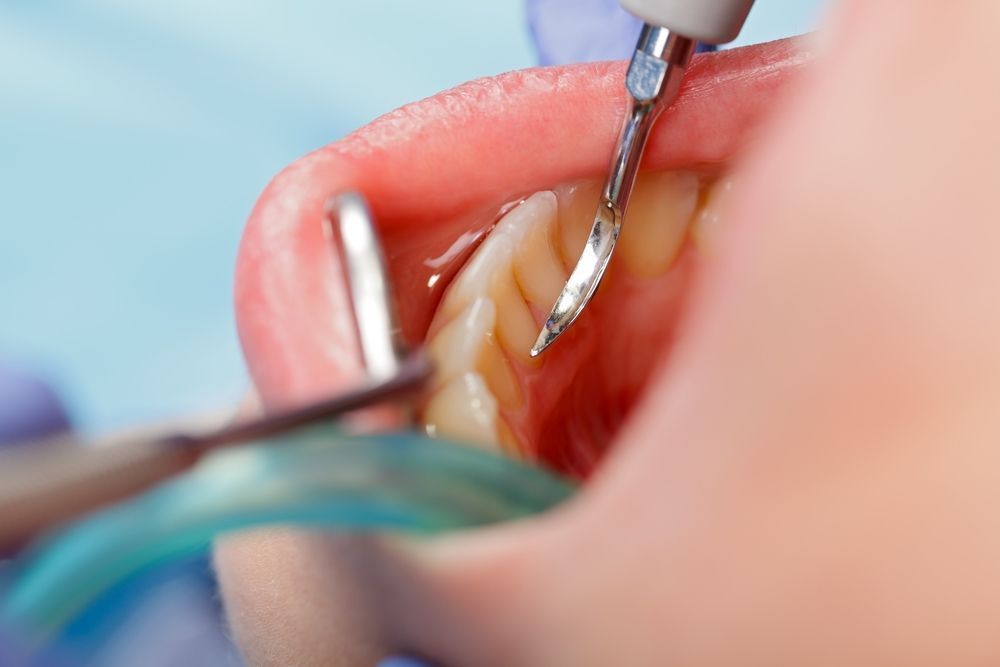 A scaler and a patient's open mouth