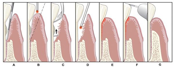 Image of laser dentistry LANAP procedure