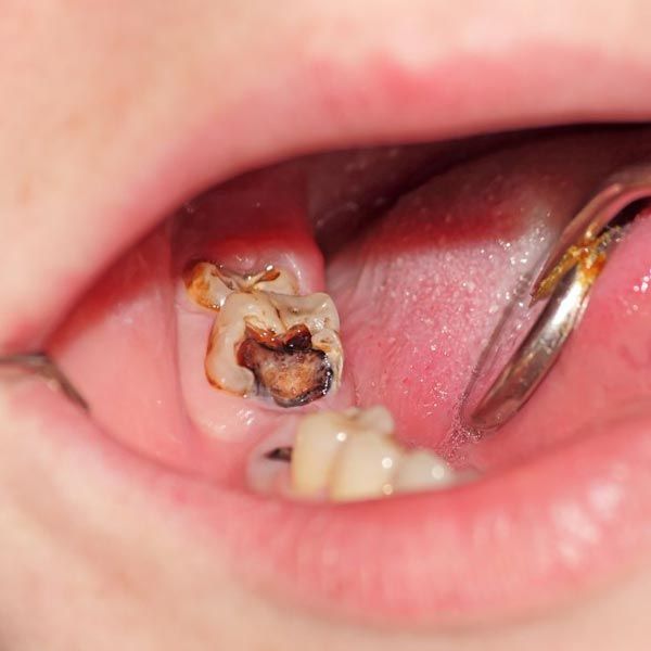 Decayed tooth