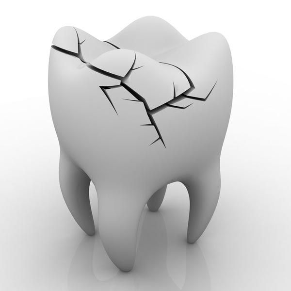 Illustration of cracked tooth
