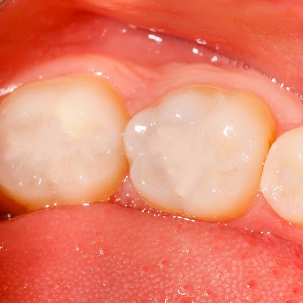 Teeth with dental fillings