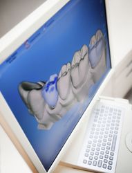 A computer monitor displays a 3D scan of a patients teeth