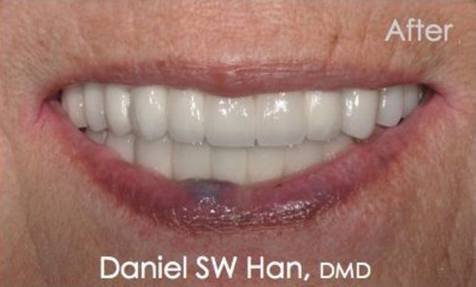 The results of full mouth reconstruction