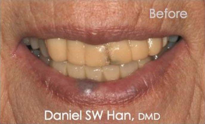 Severe dental problems before full mouth reconstruction