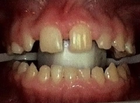 before smile makeover