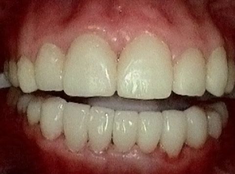 after smile makeover