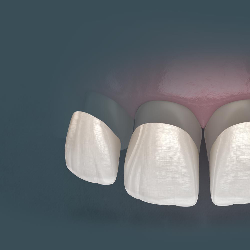veneers going over teeth
