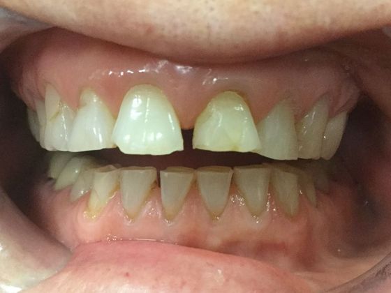 before smile makeover