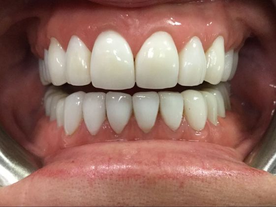 after smile makeover