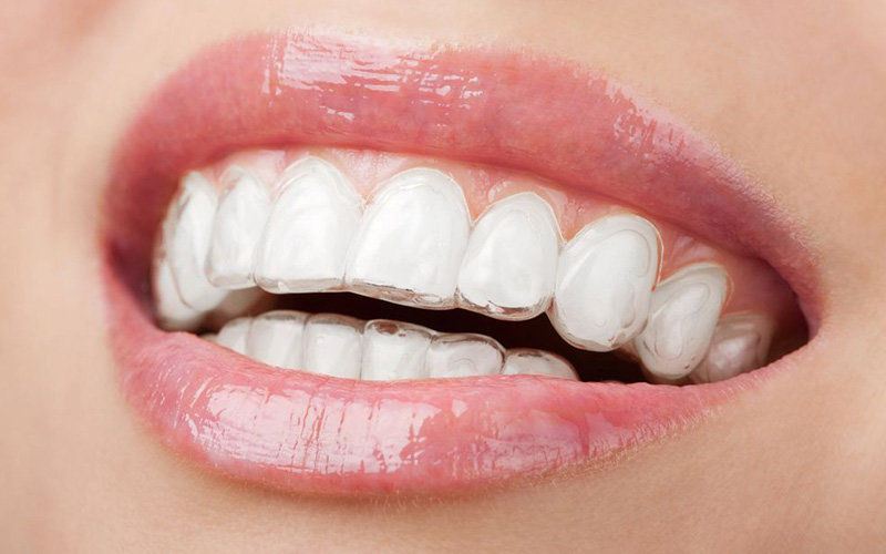 Photo of patient wearing Invisalign®