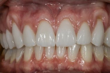Porcelain veneers bonded to natural tooth structure