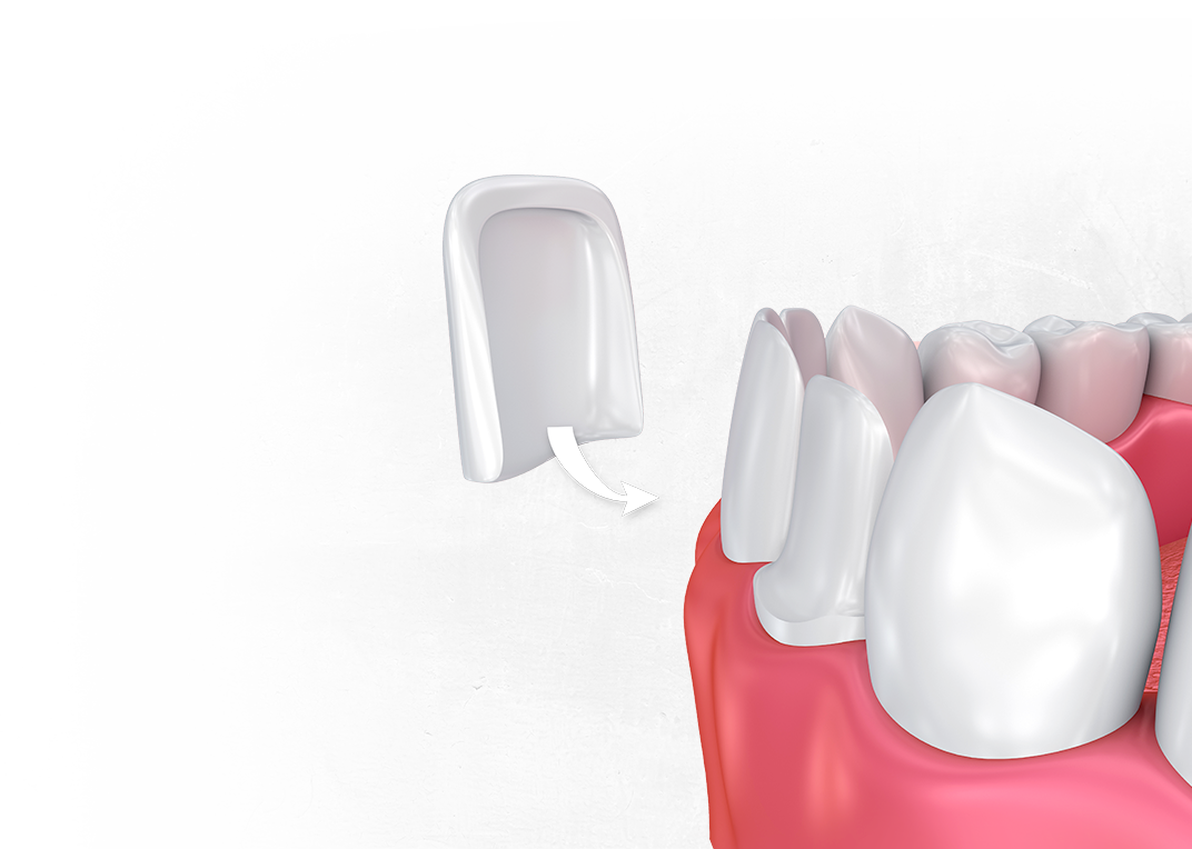 Porcelain veneers - Boston, MA