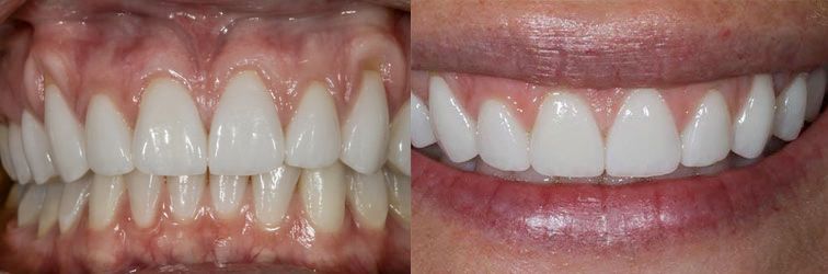 Porcelain veneers bonded to natural tooth structure