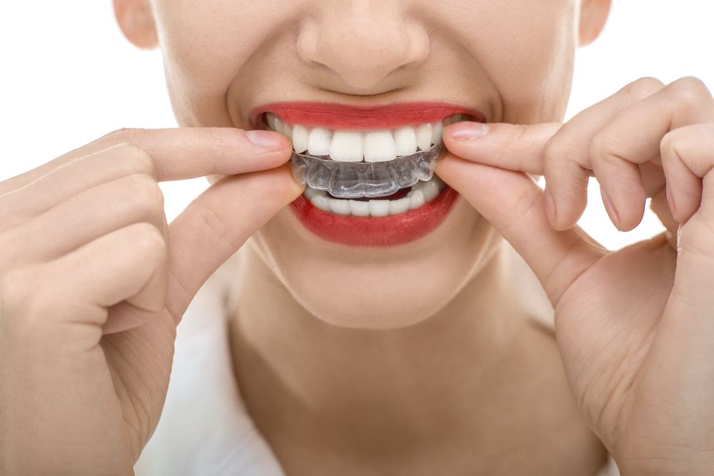 Woman with dark red lipstick fitting clear aligner over her teeth