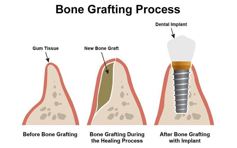 Dental bone grafting process