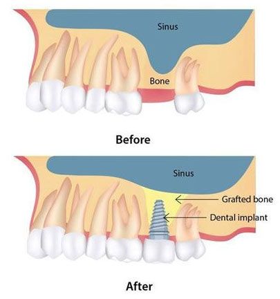 Results of a sinus lift