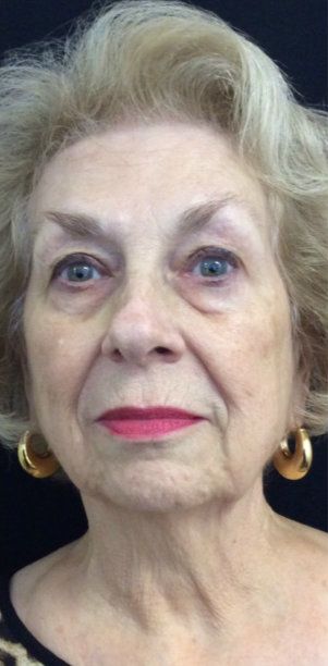 Before BOTOX photo