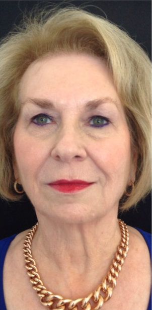 After BOTOX photo