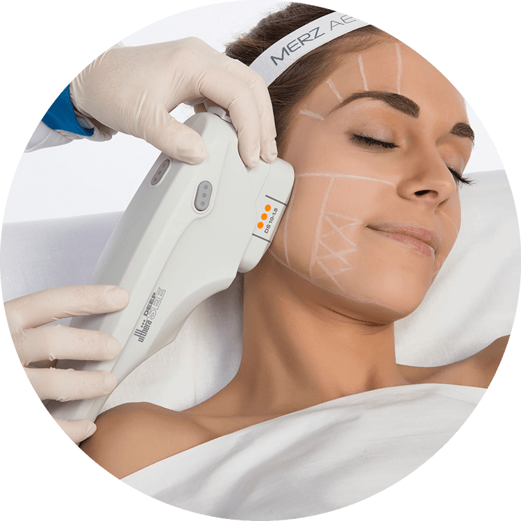 Woman's face before and after Ultherapy