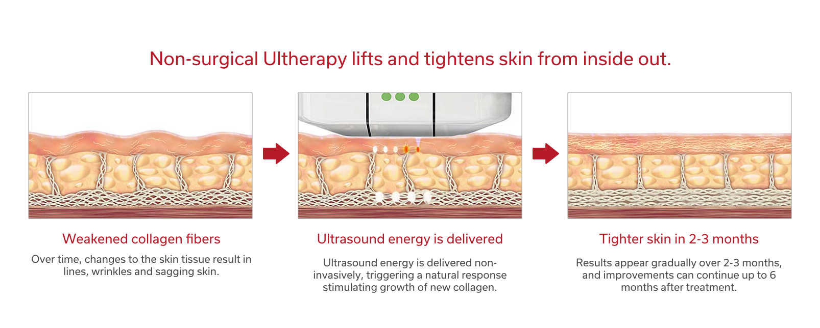 how ultherapy works